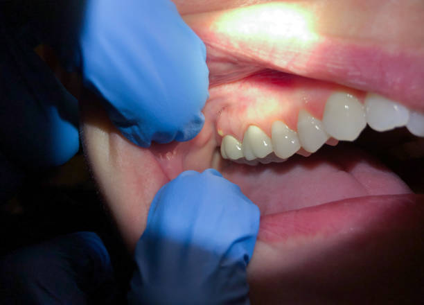 Best Broken or Chipped Tooth Repair in Mound, MN